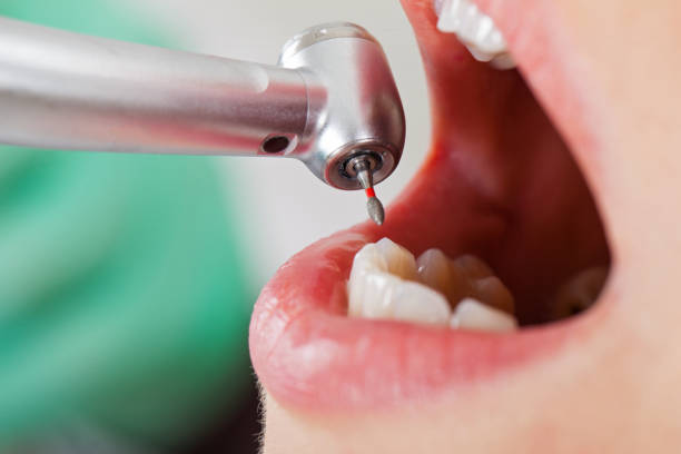 Best Lost Filling or Crown Replacement in Moses Lake North, WA